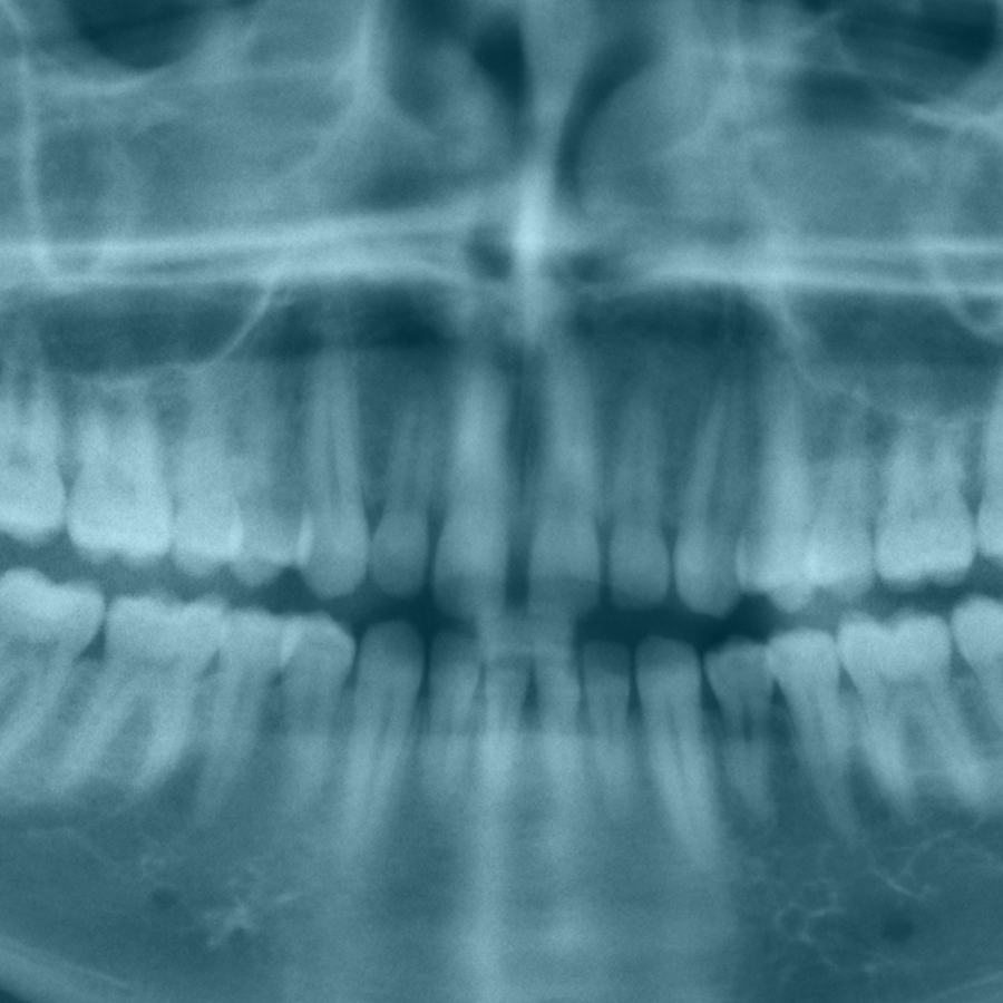 Radiologisch onderzoek voor verwijdering derde molaren onderkaak