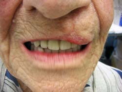 Zorgverlening aan kwetsbare ouderen met volledige gebitsprothesen