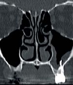 Odontogene sinusitis maxillaris op basis van doorgeperst wortelkanaalvulmateriaal