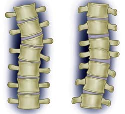 Scoliose: overzicht van typen, oorzaken, diagnostiek en behandeling 2