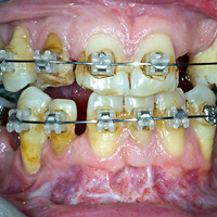 Preprothetische orthodontische behandelingen