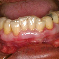 Symptomatische behandeling van lichen planus van de vaste gingiva