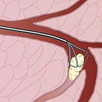 Speekselstenen: etiologie, samenstelling en behandeling