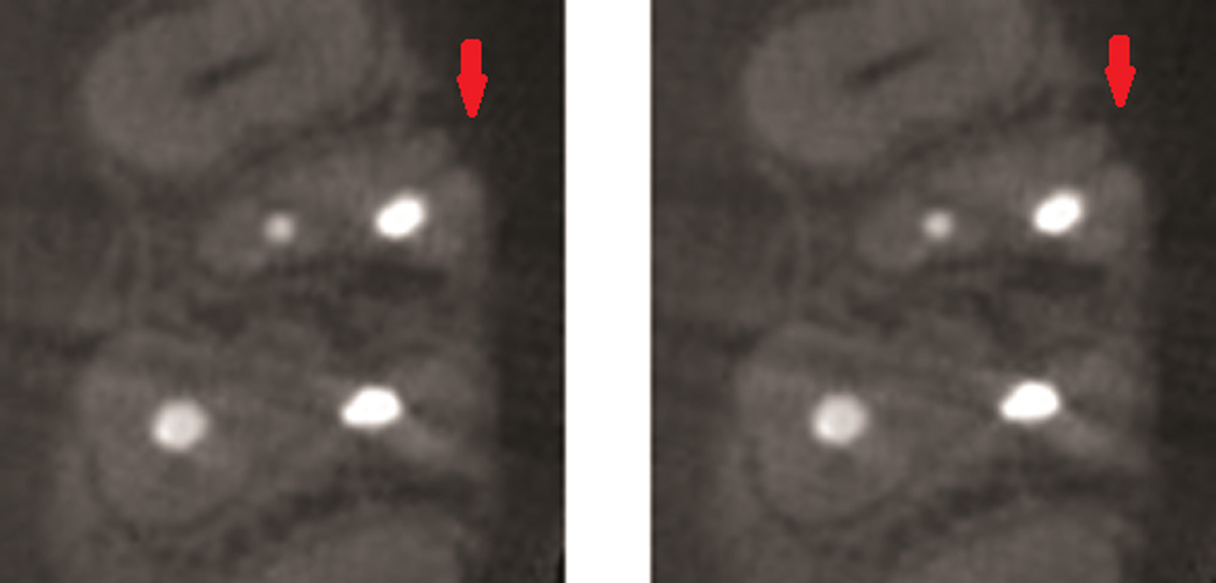 Endodontologie in beweging: nieuwe concepten, materialen en technieken 2. Conebeamcomputer­tomografie in de endodontische diagnostiek en behandelplanning