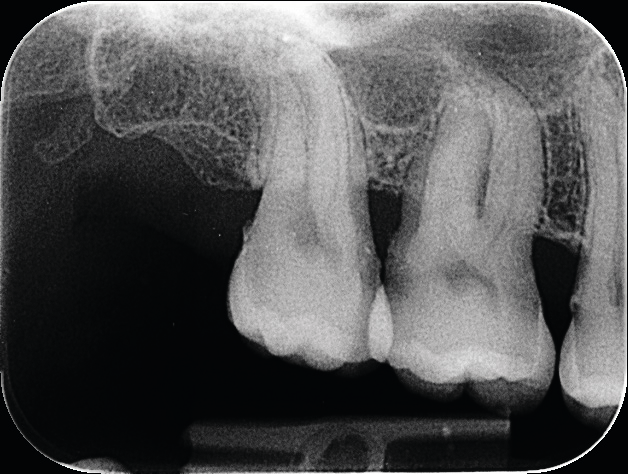  Intraorale röntgenopname van gebitselementen 17 t/m 15