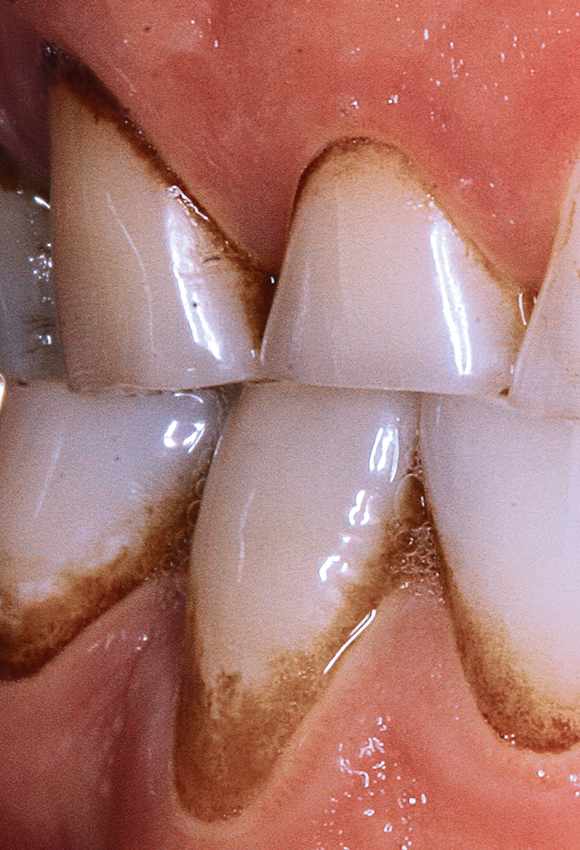 verkleuring na gebuik tandpasta met tinfluoride