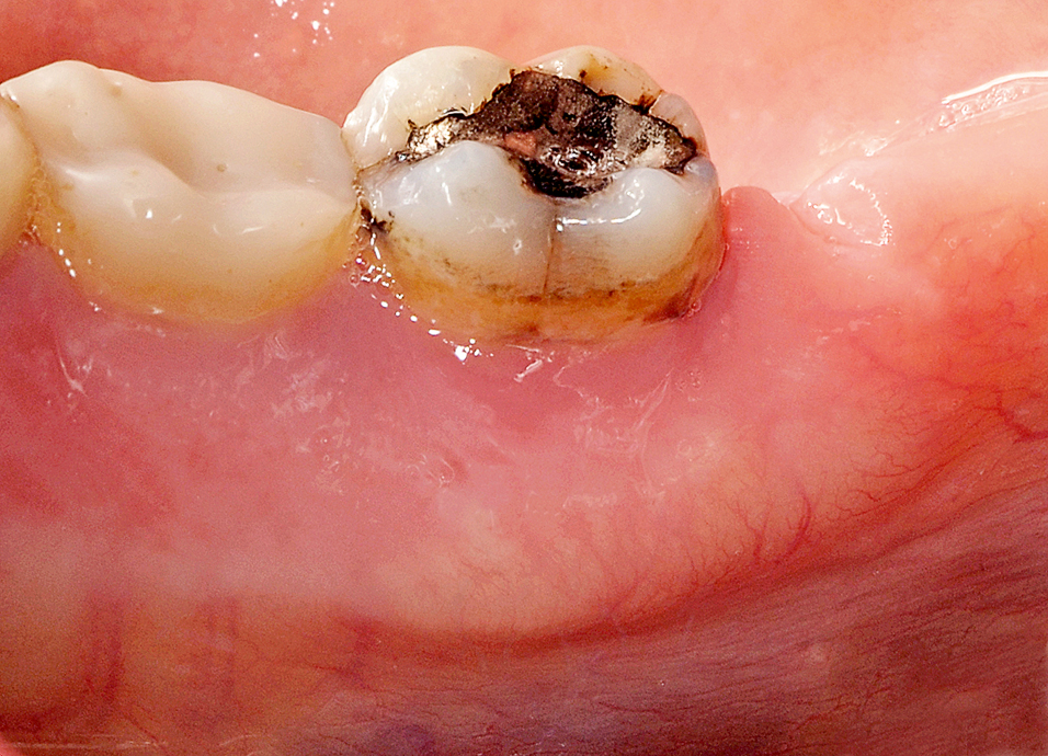 Linguale mandibulaire osteonecrose