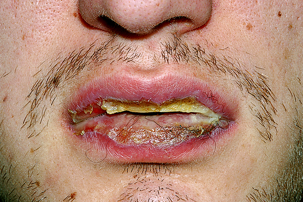 Oral medicine 6. Ulceraties van de orale mucosa