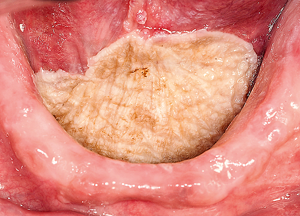 Oral medicine 7. Witte veranderingen van het mondslijmvlies