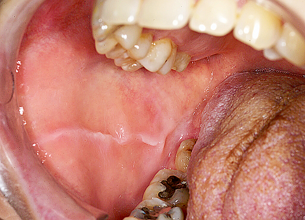 Oral medicine 7. Witte veranderingen van het mondslijmvlies