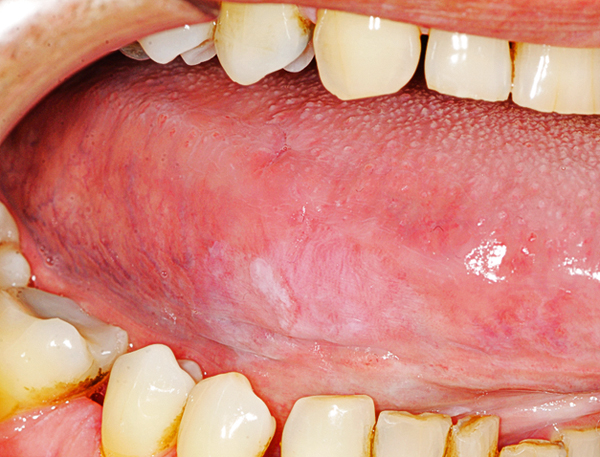 Oral medicine 8. Leukoplakie van het mondslijmvlies