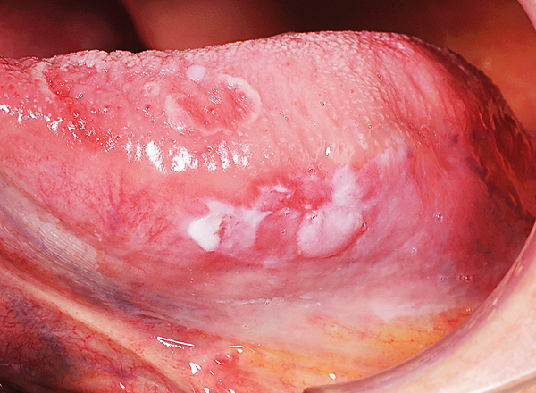 Oral medicine 8. Leukoplakie van het mondslijmvlies