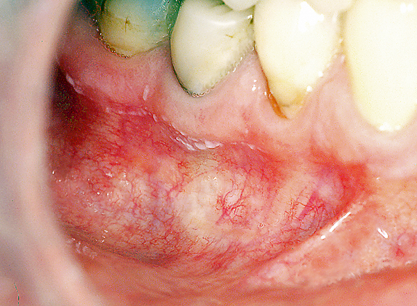 Oral medicine 8. Leukoplakie van het mondslijmvlies