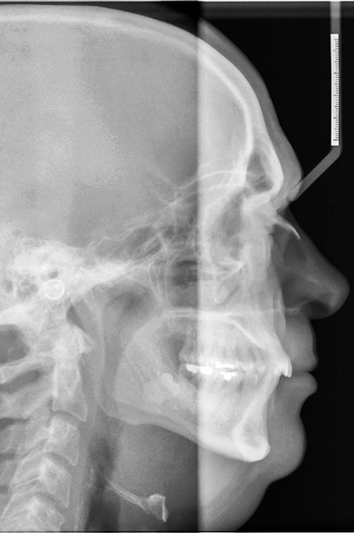 Bimaxillaire osteotomie als mogelijke behandeling voor ernstig obstructieve slaapapneu