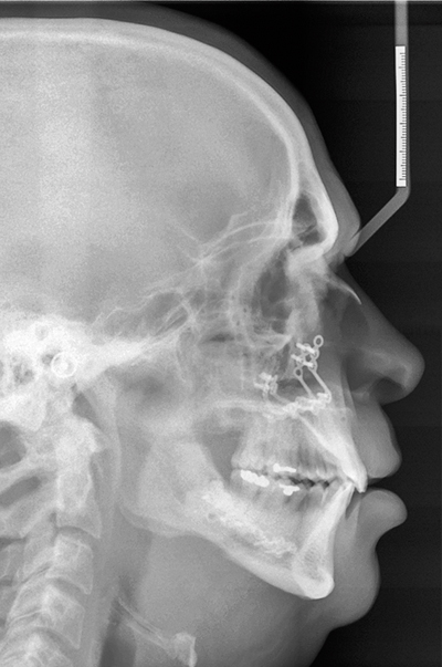 Bimaxillaire osteotomie als mogelijke behandeling voor ernstig obstructieve slaapapneu