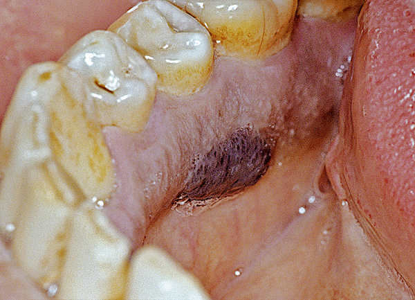 Oral medicine 10. Pigmentaties van het mondslijmvlies