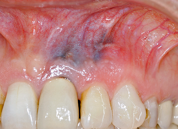 Oral medicine 10. Pigmentaties van het mondslijmvlies