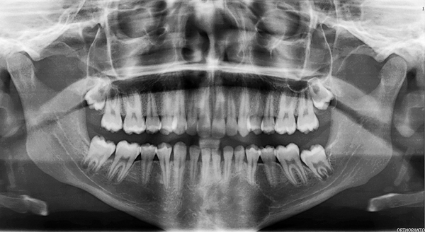 Pijnlijke submandibulaire zwelling blijkt zeldzame odontogene tumor