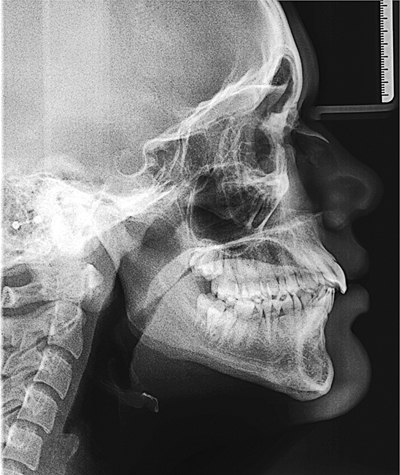 Pijnlijke submandibulaire zwelling blijkt zeldzame odontogene tumor