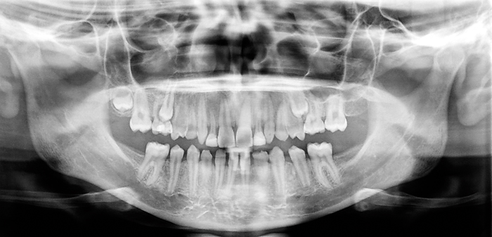 Preprothetische orthodontische behandelingen