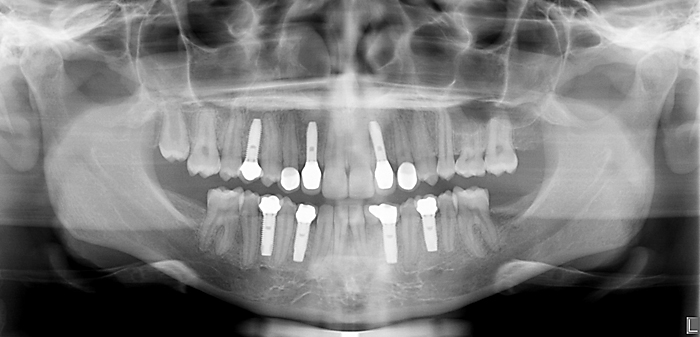 Preprothetische orthodontische behandelingen