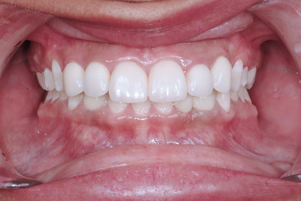 Preprothetische orthodontische behandelingen