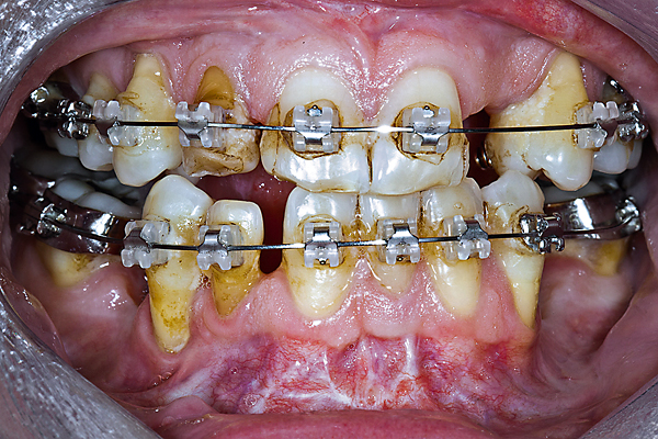 Preprothetische orthodontische behandelingen