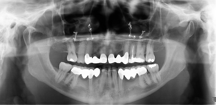 Preprothetische orthodontische behandelingen