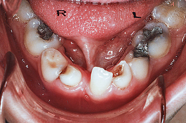 Preprothetische orthodontische behandelingen