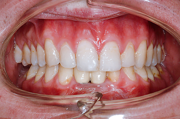 Preprothetische orthodontische behandelingen