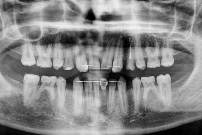 Preprothetische orthodontische behandelingen