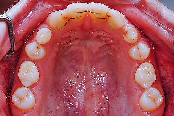 Preprothetische orthodontische behandelingen