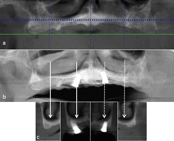 Retentieproblemen van de bovenprothese: is het plaatsen van 2 palatinale implantaten de oplossing?