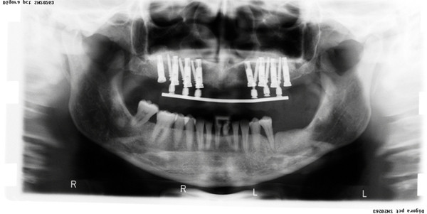Het gebruik van tijdelijke implantaten in de prothetische tandheelkunde