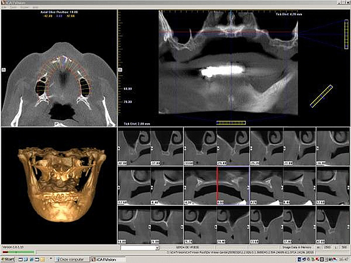 Het gebruik van tijdelijke implantaten in de prothetische tandheelkunde