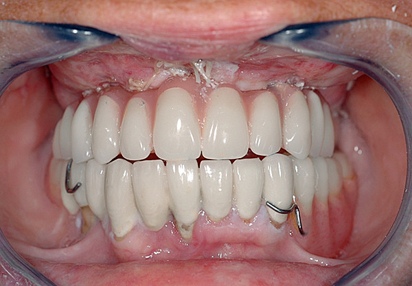 Het gebruik van tijdelijke implantaten in de prothetische tandheelkunde