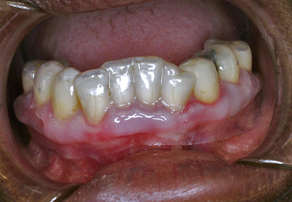 Symptomatische behandeling van lichen planus van de vaste gingiva