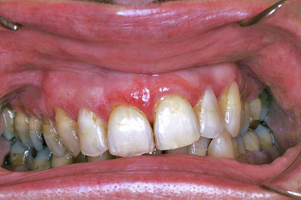 Symptomatische behandeling van lichen planus van de vaste gingiva