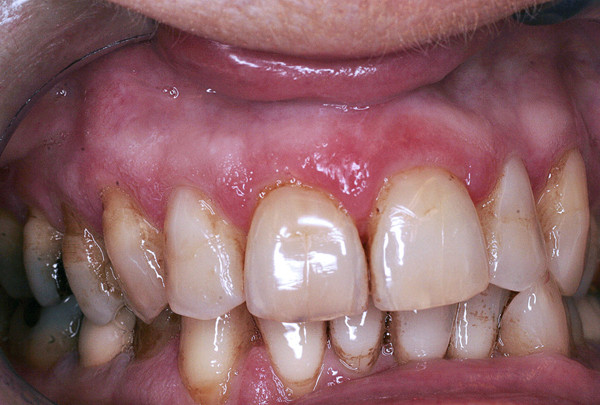 Symptomatische behandeling van lichen planus van de vaste gingiva