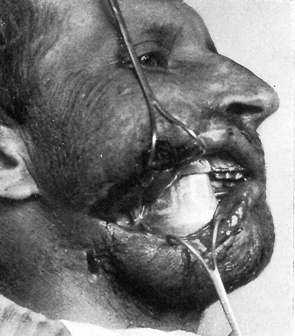 De Grote Oorlog 1914-1918 en de mondziekten, kaak- en aangezichtschirurgie