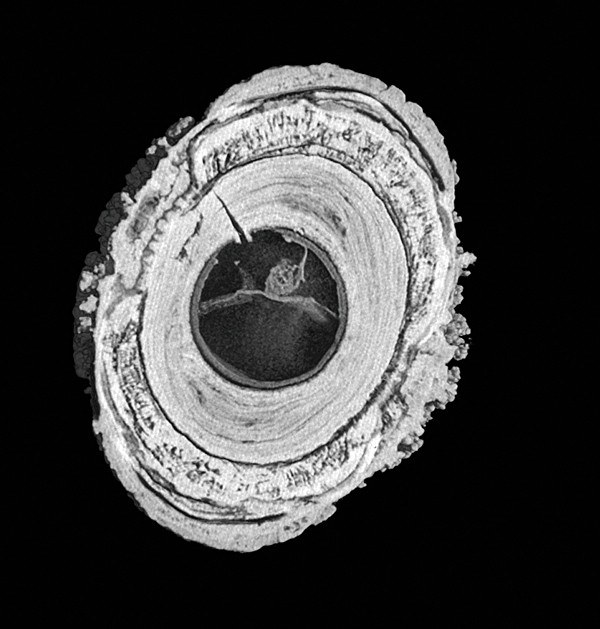 Speekselstenen: etiologie, samenstelling en behandeling