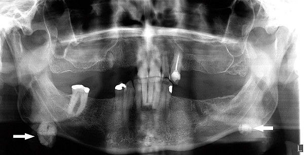 Speekselstenen: etiologie, samenstelling en behandeling