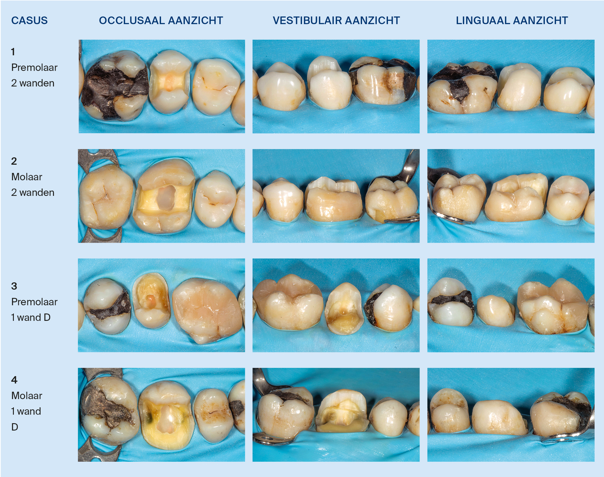 Endodontisch behandelde gebitselementen na verwijdering restauratie