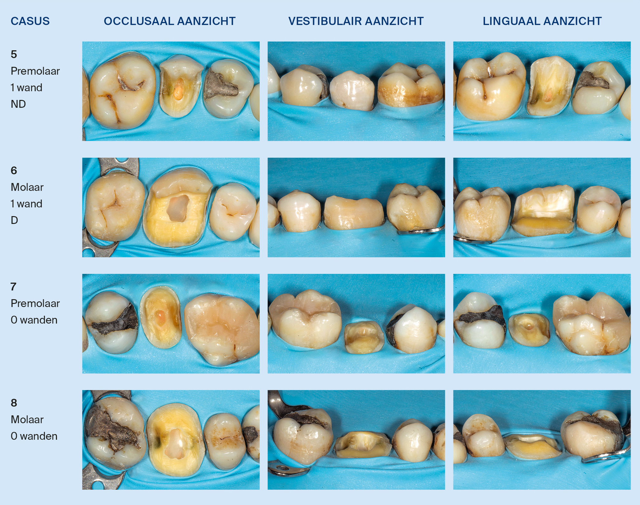 Endodontisch behandelde gebitselementen in de posterieure zone