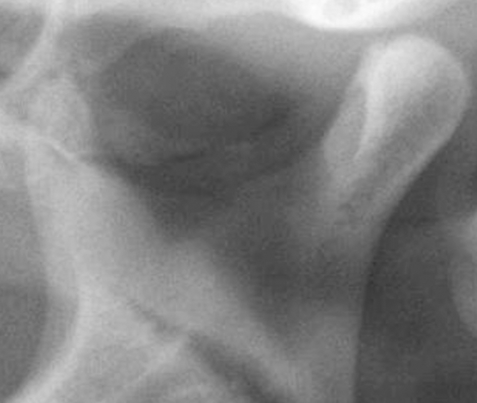Kaakkopjes niet loodrecht op panoramische röntgenopname