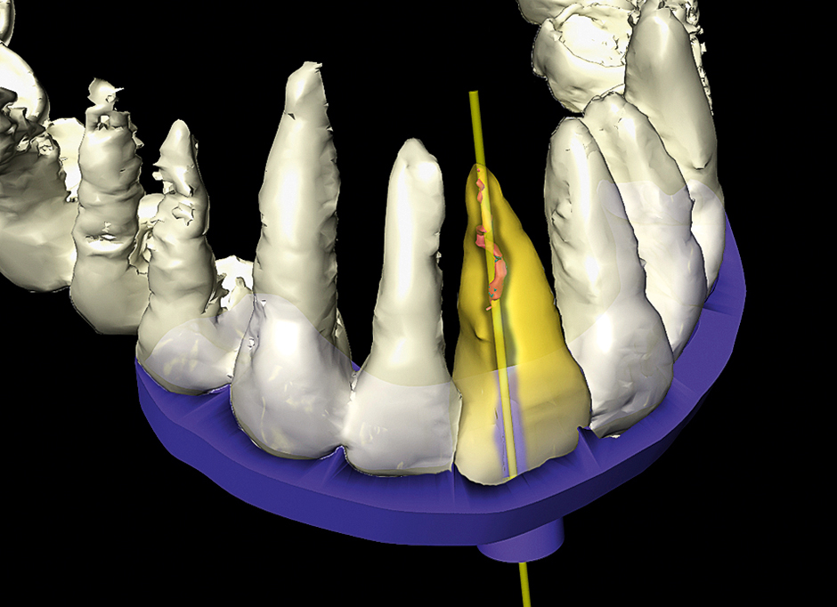 Ontwerp geleidemal voor endo-behandeling met software