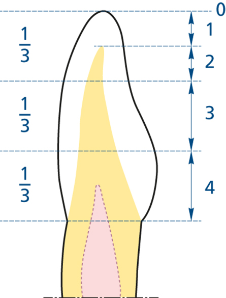 Schematische weergave occlusale/incisale vijfpuntenschaal in een tand