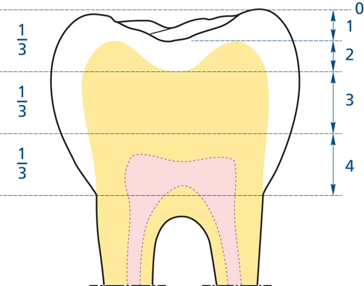 Schematische weergave van de occlusale/incisale vijfpuntenschaal in een molaar