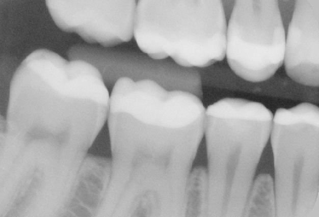 Bitewing-röntgenopname rechts na opbouw