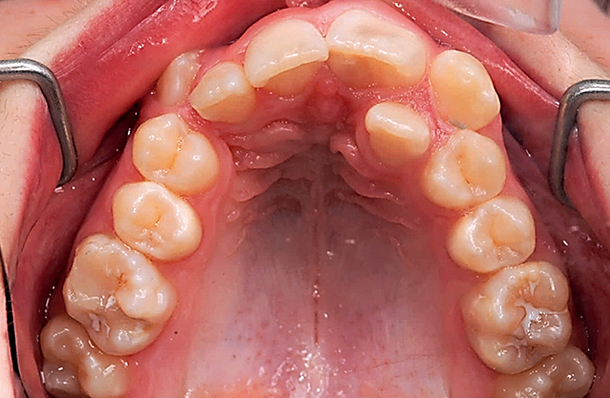 malocclusie met een gecompro-mitteerde centrale bovenincisief, boven